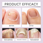 (BUY 1 GET 1 FREE) FungiFree® Bee Venom Nail Treatment Solution Serum